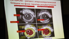 Статины побеждают атеросклеротические изменения в сосудах.