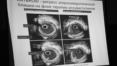 Статины побеждают атеросклеротические изменения в сосудах.