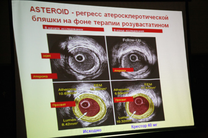 Статины побеждают атеросклеротические изменения в сосудах.